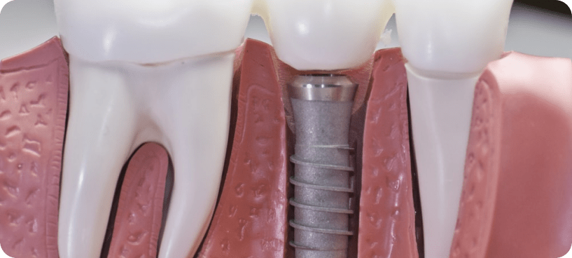 Don’t Wait-Get Your Smile Back with Dental Implants Now