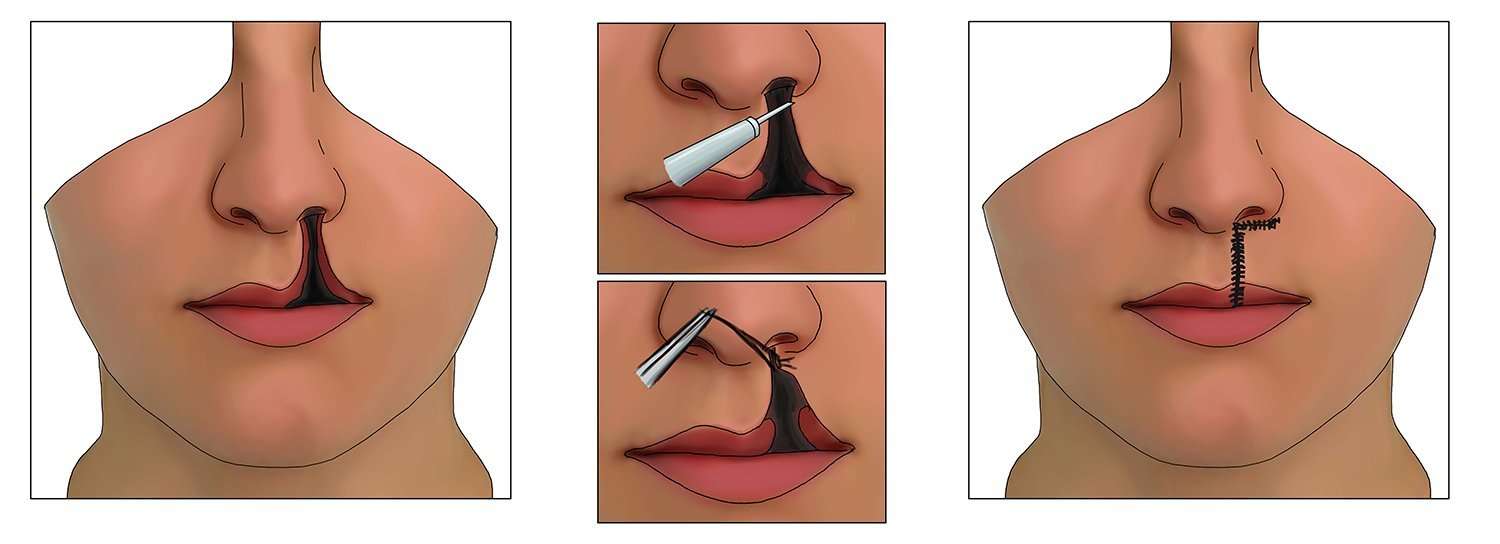 https://wellnessvoyage.us/wp-content/uploads/2025/05/Cleft-Lip-and-Palate-img.jpg