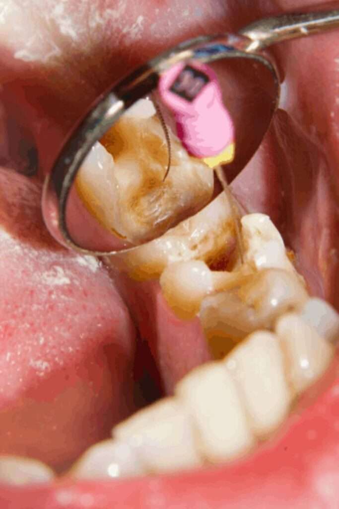 Endodontics Root Canal Treatment img. jpg