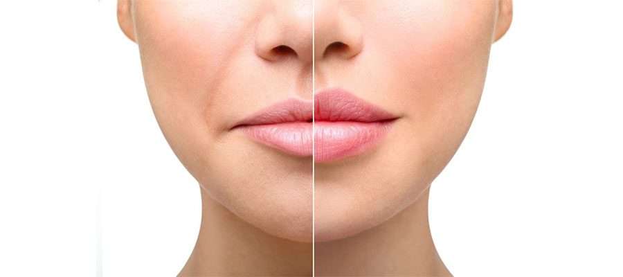 Facial Filler Treatments and Lip Contouring