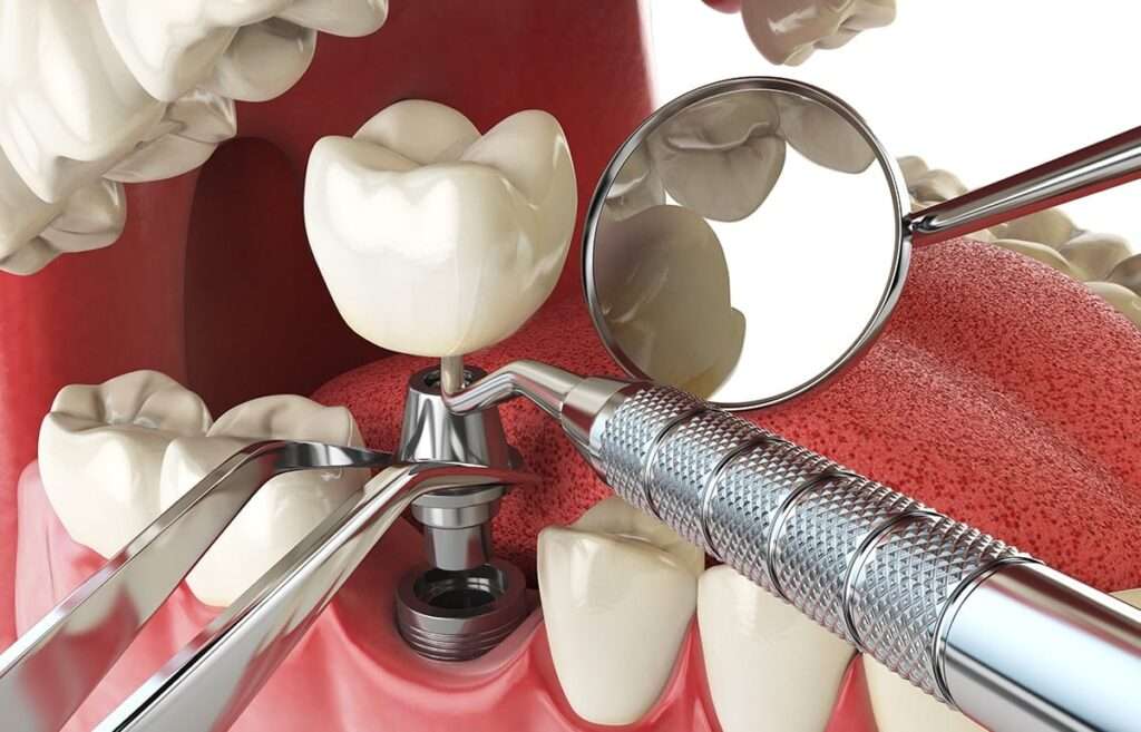 Dental Implants in Turkey