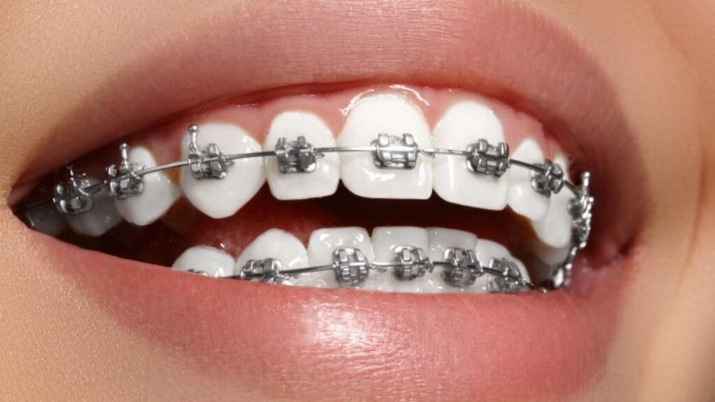Orthodontic treatment Explained Orthodontic treatment with affordability